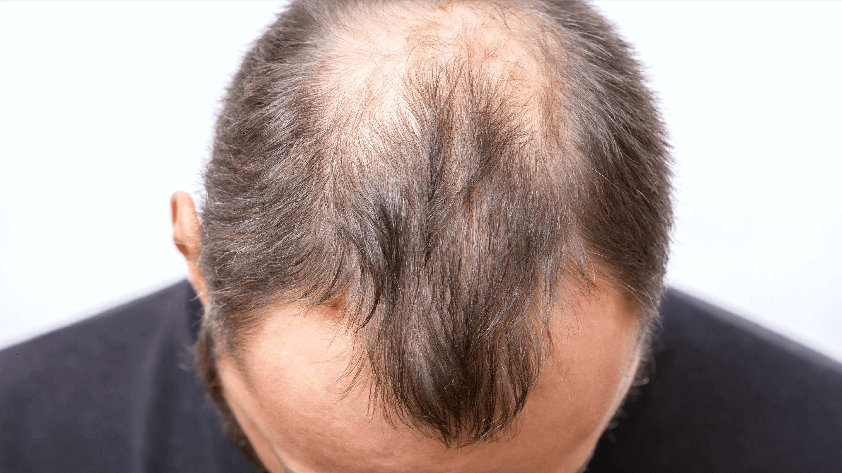 Benefits of PRP & GFC Hair Treatment for your hair concerns| Bodycraft