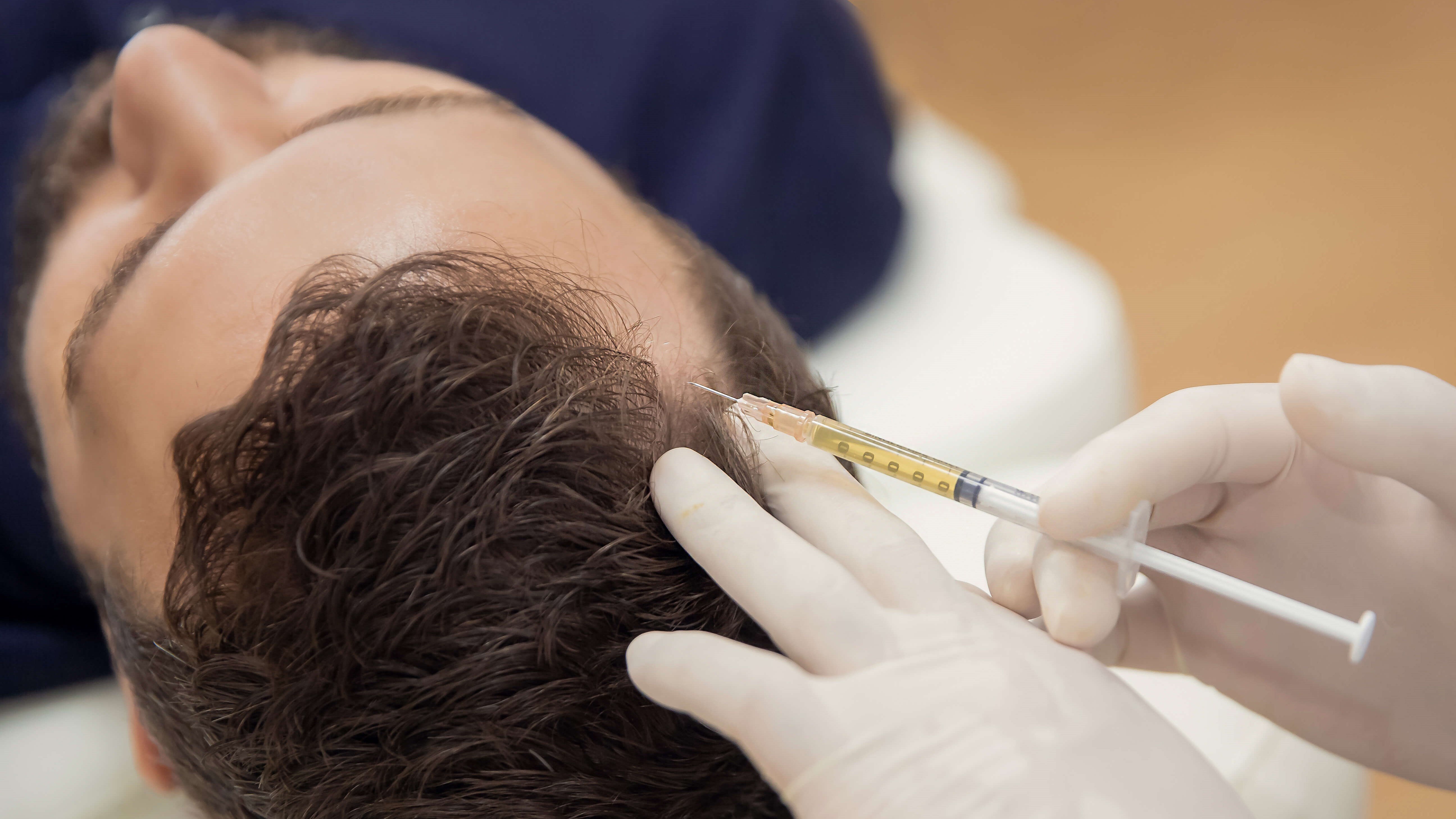 Turning Back the Clock: PRP for Hair Loss
