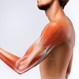 Biceps Tendinitis