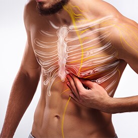 Intercostal Neuralgia