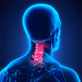 Thoracic Facet Arthritis