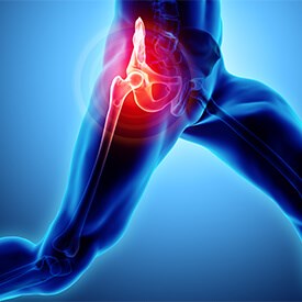 Iliopsoas Bursitis